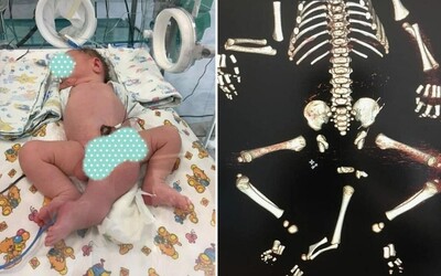 Chlapček sa narodil bez konečníka, s dvomi pohlavnými orgánmi a tromi nohami. Operácia mu zachránila život