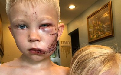 Chlapec zachránil život malej sestre počas útoku psa. Skončil s 90 stehmi na tvári, ale vraj by to urobil znova