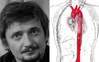 Čo je to akútna disekcia aorty, na ktorú zomrel Daniel Heriban? Začína sa bolesťou hrudníka a chrbta, úmrtnosť je až 73 %