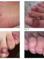Covid-19 spôsobuje u mladých aj rany na prstoch nôh. Lekári ho tak dokážu identifikovať