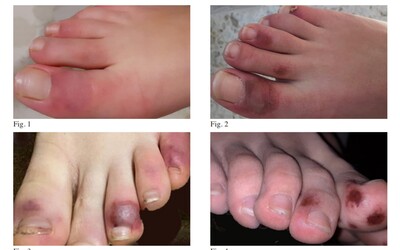 Covid-19 spôsobuje u mladých aj rany na prstoch nôh. Lekári ho tak dokážu identifikovať