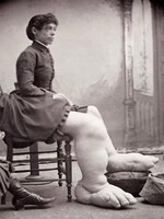 Fanny Mills měla nohy oteklé do velkých rozměrů. Vydělala si i 100 tisíc korun týdně