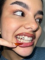 Gen Z si zamilovala tooth gems: Pri nekvalitnej práci sa môžu zapichnúť do ďasien, čo si o nich myslia stomatológovia?