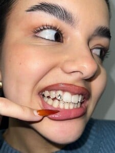 Gen Z si zamilovala tooth gems: Pri nekvalitnej práci sa môžu zapichnúť do ďasien, čo si o nich myslia stomatológovia?