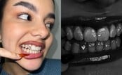 Gen Z si zamilovala tooth gems: Pri nekvalitnej práci sa môžu zapichnúť do ďasien, čo si o nich myslia stomatológovia?