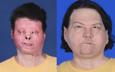 Historicky prvá úspešná transplantácia tváre a rúk. Na riskantnej operácii spolupracovalo vyše 140 zdravotníkov