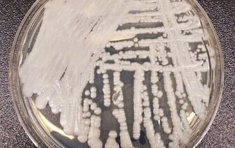 Houbové infekce se stále více šíří. Nebezpečná kvasinka vyvolává obavy, v minulosti objevila i v Česku