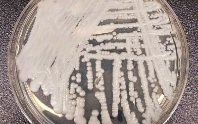 Houbové infekce se stále více šíří. Nebezpečná kvasinka vyvolává obavy, v minulosti objevila i v Česku