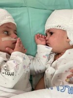 Izraelští lékaři oddělili siamská dvojčata, která byla k sobě srostlá hlavami. Operace se zúčastnilo 50 osob