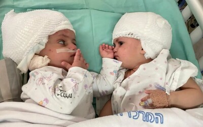 Izraelští lékaři oddělili siamská dvojčata, která byla k sobě srostlá hlavami. Operace se zúčastnilo 50 osob