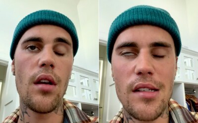 Justin Bieber odhalil ochorenie, pre ktoré mu ochrnula polovica tváre. Ruší preto koncerty