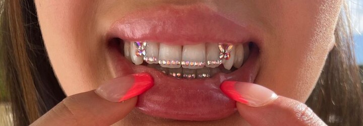Kamínky na zubech jako trend i riziko pro tvé zuby. Popisujeme, na co si dát při jejich aplikaci pozor