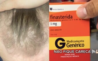 Liečba plešatosti finasteridom: Môže nahradiť transplantáciu vlasov a aké nežiaduce účinky lieku desia mužov?