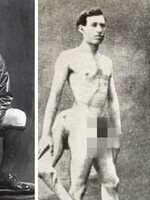 Měl tři nohy a dva pohlavní orgány. Francouzská prostitutka se dvěma vagínami ho prý chtěla pro sebe