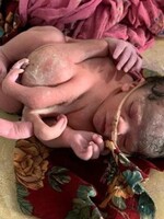 Mladej Indke sa narodilo dieťa s tromi rukami a štyrmi nohami. Podľa doktorov malo ísť o trojičky