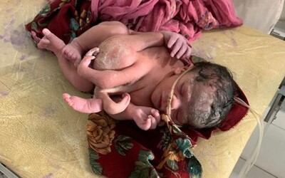 Mladé Indce se narodilo dítě se třema rukama a čtyřma nohami. Podle doktorů mělo jít o trojčata