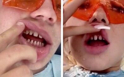Mladí si vo veľkom orezávajú zuby, aby si na ne nasadili nové. Zubárka varuje pred zdravotnými problémami