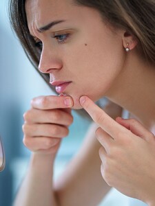 Môžeš sa zbaviť akné za jeden deň? Dermatologička radí, ako zmierniť vzhľad akné čo najrýchlejšie