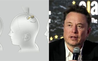 Musk prepísal históriu: úspešne implantoval čip do mozgu človeka. Prvý pacient vie ovládať zariadenia iba pomocou mysle