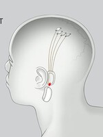 Musk priznal, že pri implantovaní čipu do mozgu človeka nastali problémy. Ubezpečil, že pacient je mimo ohrozenia života