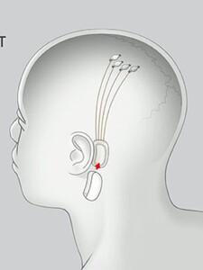 Musk priznal, že pri implantovaní čipu do mozgu človeka nastali problémy. Ubezpečil, že pacient je mimo ohrozenia života