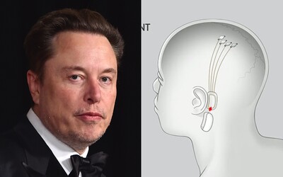 Musk přiznal, že při implantování čipu do mozku člověka nastaly problémy. Ujistil, že pacient je mimo ohrožení života