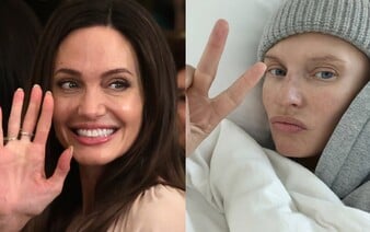 Mutácia v géne BRCA: Angelina Jolie prišla o prsníky aj vaječníky, modelke Biance Balti sa rakovina nevyhla ani po mastektómii