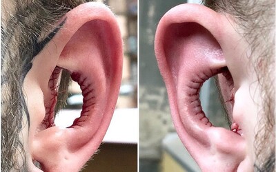 Muž precestoval tisíce kilometrov, aby si nechal odstrániť časť uší kvôli novému „módnemu výstrelku“