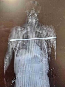 Muž v Česku spadol pri zbere čerešní, kovová tyč mu prepichla obe pľúca. Zdravotníci z hrozivej nehody zverejnili röntgenový záber