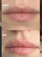 Může výplň rtů kyselinou hyaluronovou škodit zdraví? Zeptali jsme se odborníka