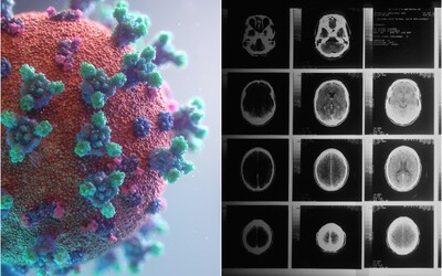 Nákaza koronavírusom môže mať dlhodobý negatívny vplyv na mozog aj pri miernom priebehu, ukázali prvé výsledky štúdie