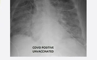 Obrovský rozdiel medzi pľúcami očkovaného a neočkovaného pacienta s koronavírusom. Touto snímkou lekár otvára ľuďom oči