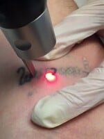 Odstraňovanie tetovaní je čoraz populárnejšie: Nerozvážnosť či fušerskú prácu môže napraviť laser