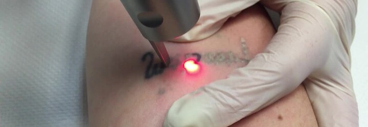 Odstraňovanie tetovaní je čoraz populárnejšie: Nerozvážnosť či fušerskú prácu môže napraviť laser