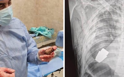 Operace, která se zapíše do učebnic medicíny: Ukrajinští chirurgové odstranili z hrudi vojáka nevybuchlý granát