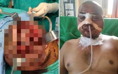 Pluh z traktoru farmáři zlámal kosti a strhl kůži. 7hodinová operace mu zachránila život