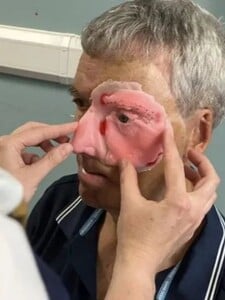 Po nehodě přišel o polovinu tváře. 3D tiskárna mu ji pomohla získat zpět