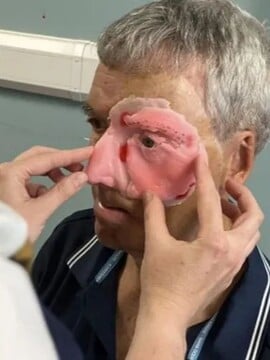 Po nehodě přišel o polovinu tváře. 3D tiskárna mu ji pomohla získat zpět