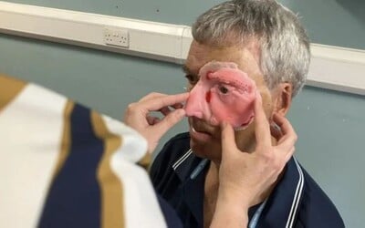 Po nehodě přišel o polovinu tváře. 3D tiskárna mu ji pomohla získat zpět