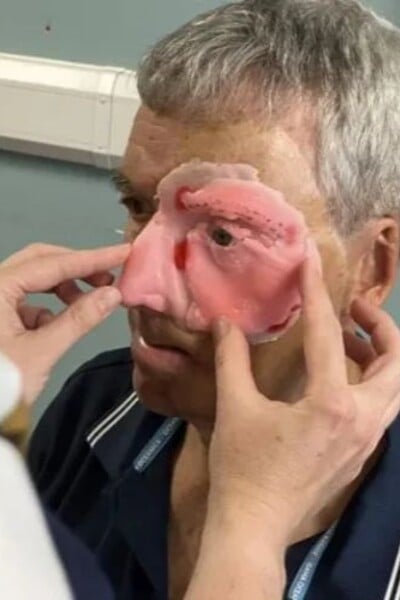Po nehodě přišel o polovinu tváře. 3D tiskárna mu ji pomohla získat zpět