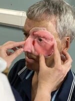 Po nehode s opitým vodičom prišiel o polovicu tváre. Vďaka 3D tlačiarni dostal muž nový život