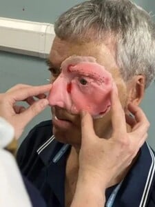 Po nehode s opitým vodičom prišiel o polovicu tváre. Vďaka 3D tlačiarni dostal muž nový život