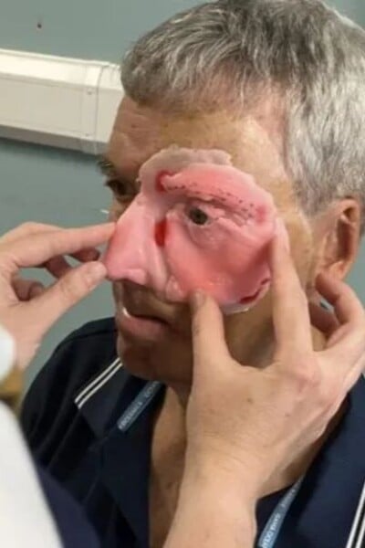 Po nehode s opitým vodičom prišiel o polovicu tváre. Vďaka 3D tlačiarni dostal muž nový život