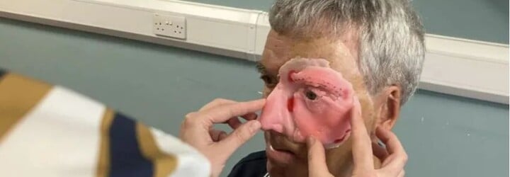 Po nehode s opitým vodičom prišiel o polovicu tváre. Vďaka 3D tlačiarni dostal muž nový život