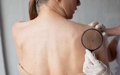 Počet nádorů kůže podle odborníků přibývá. Kdy a kde se nechat zdarma vyšetřit?