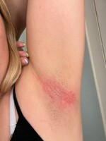 Populárny deodorant spôsobil ženám vážnu kožnú reakciu. Predávajú ho aj na Slovensku