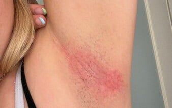 Populárny deodorant spôsobil ženám vážnu kožnú reakciu. Predávajú ho aj na Slovensku