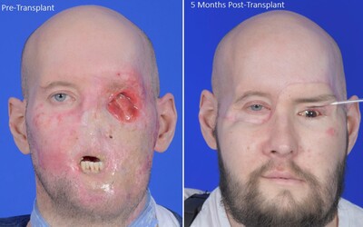 Prelom v medicíne: Chirurgovia pacientovi prvýkrát transplantovali celé oko aj s časťou tváre
