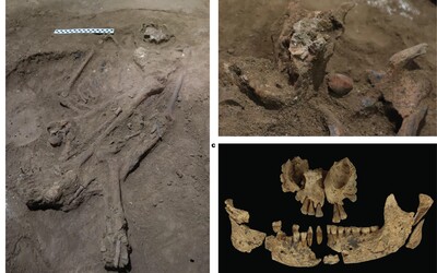První chirurgická operace byla provedena před více než 30 tisíci lety, šlo o amputaci nohy