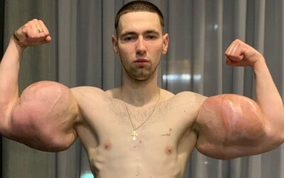 Ruský Pepek námořník, který si napíchal bicepsy olejem, musel podstoupit operaci. Vyndávali mu odumřelé svaly